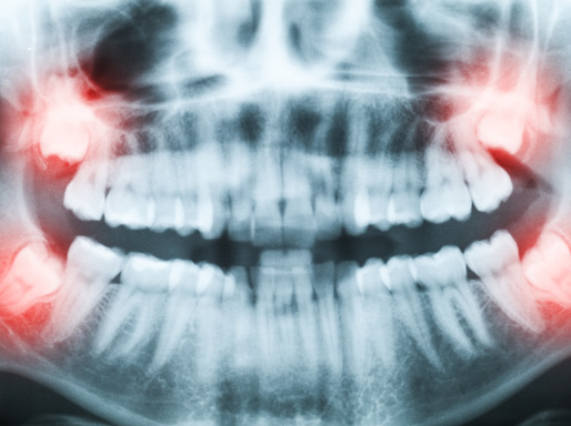 Wisdom Teeth Removal